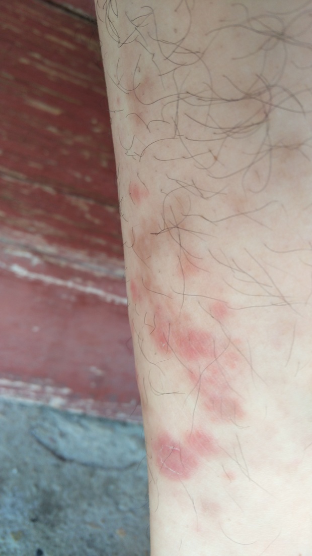 想助孕!过敏性湿疹怎么治疗"风和日丽"-第2张图片-吉泽网