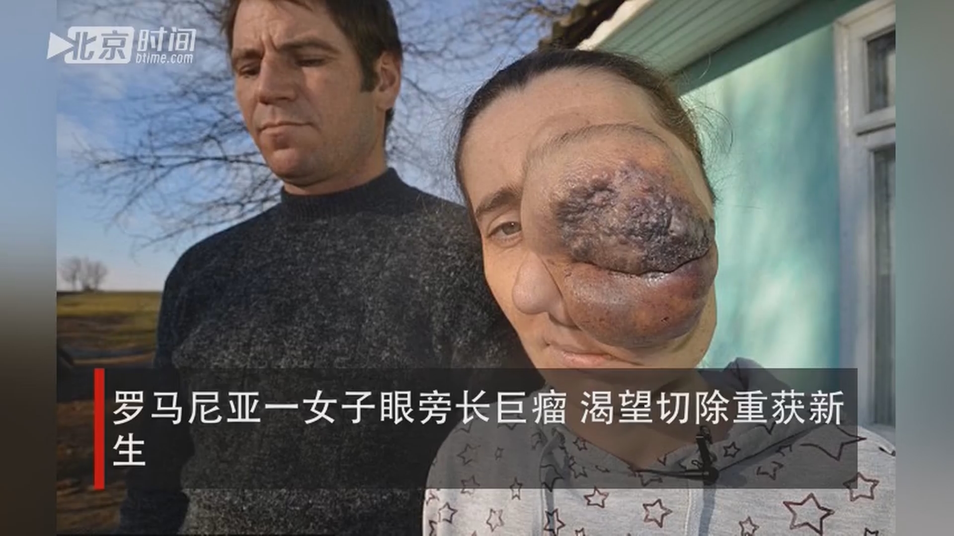 罗马尼亚一女子眼旁长巨瘤 渴望切除重获新生