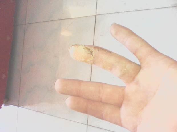 钢钉工伤给报销 骨折钢钉在工伤保险范围内