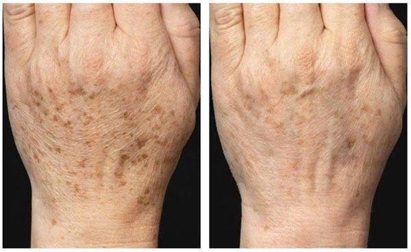 "老年斑脱斑",焕然一新